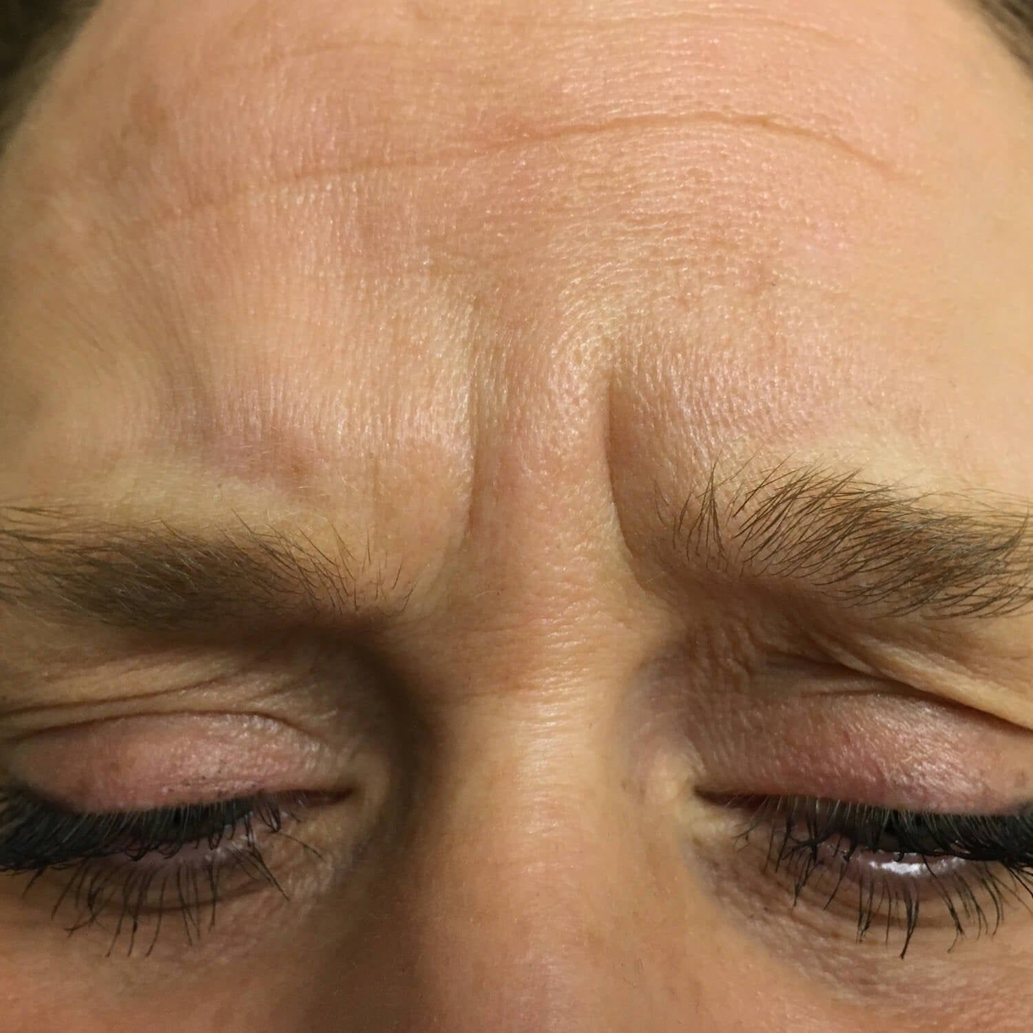 A close-up of a person's forehead, showing vertical frown lines between the eyebrows with eyes closed.