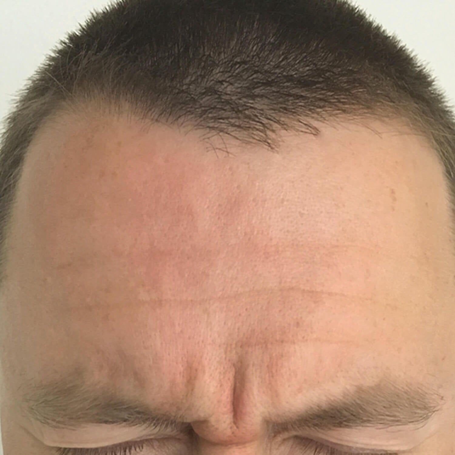 Close-up of a person's forehead showing horizontal expression lines and vertical creases between the eyebrows.