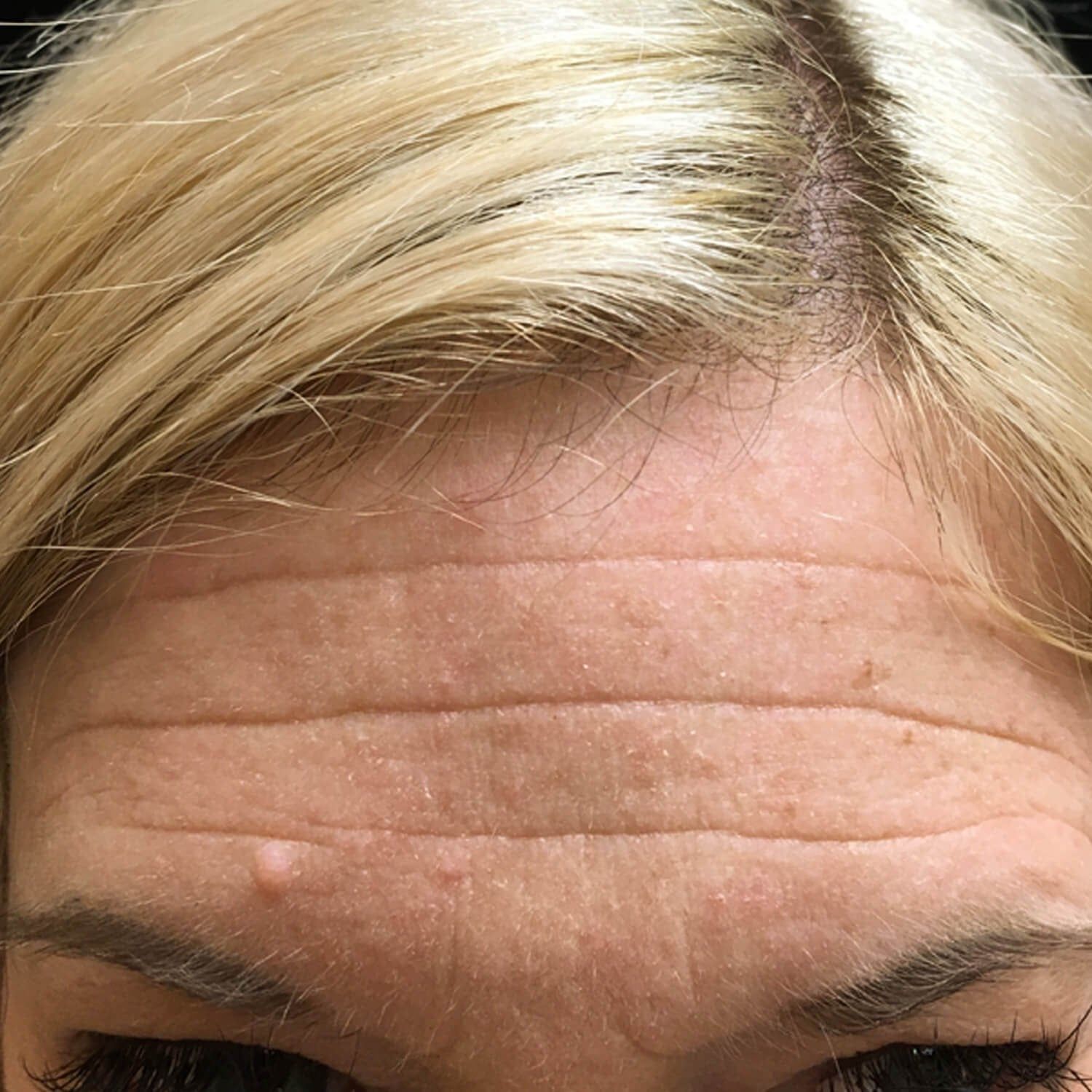 Close-up of a forehead with prominent horizontal wrinkles and a small, raised skin bump above the left eyebrow.