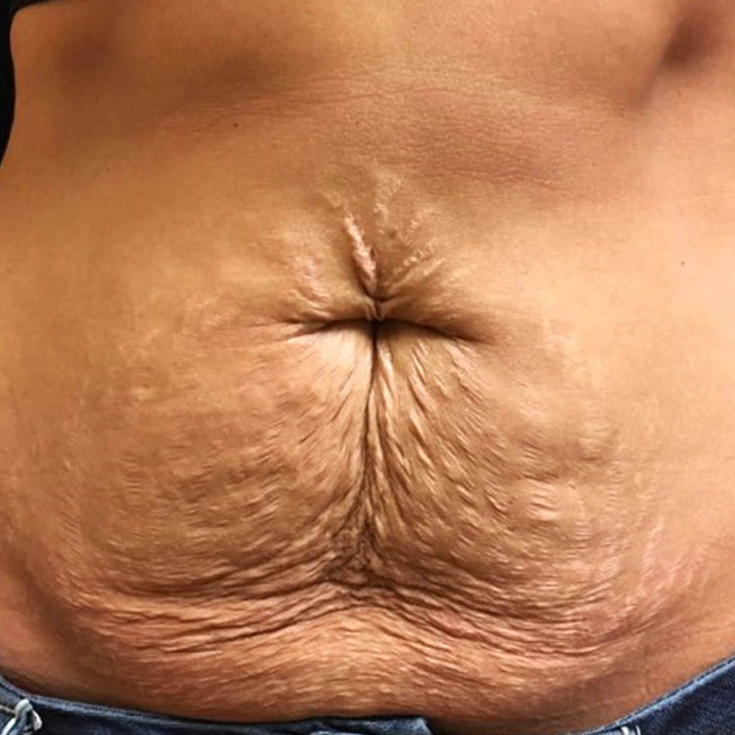 A close-up view of the abdomen showing loose, wrinkled skin with fine lines and stretch marks around the navel.
