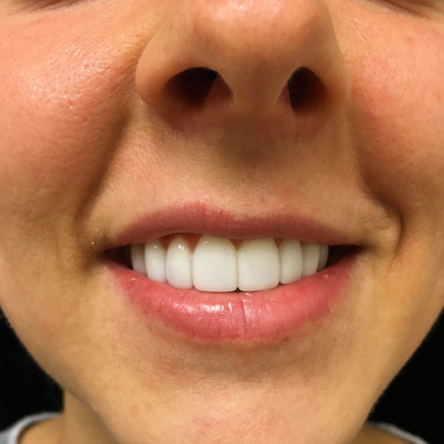 A close-up view of a smiling mouth showing a set of bright white, uniform porcelain dental veneers.