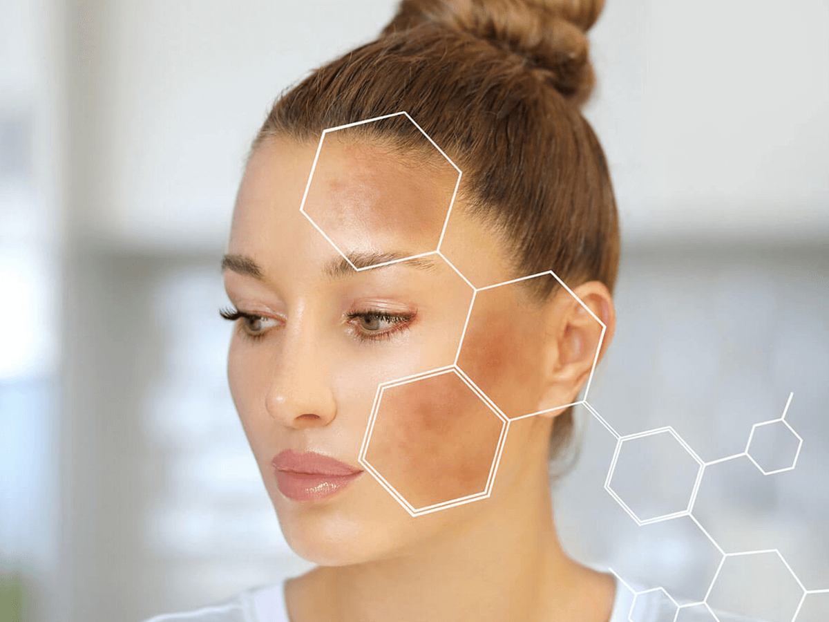 A person with hyperpigmentation patches on their forehead and cheek, overlaid with white molecular structure graphics.