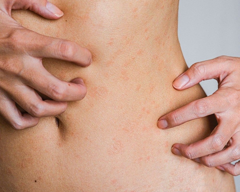 Close-up of hands scratching a skin rash on a person's abdomen.