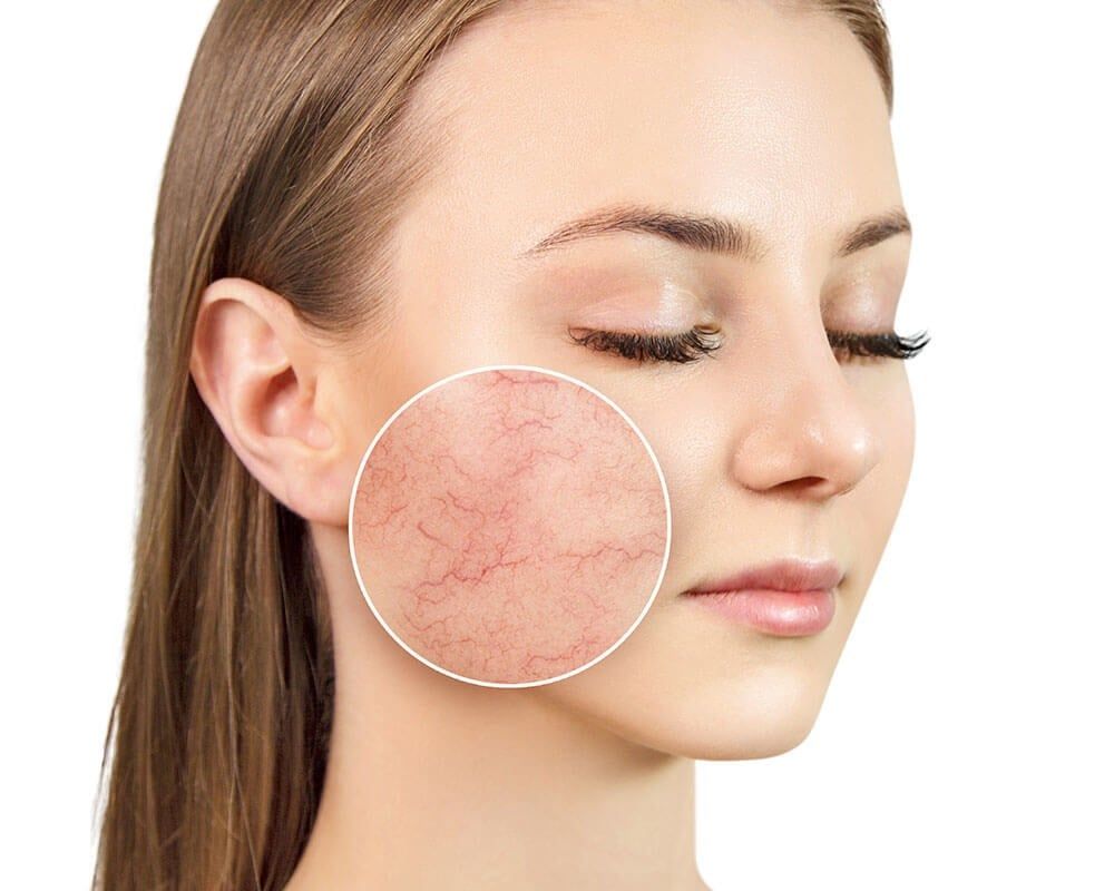 Close-up of a person with a circular inset highlighting visible red spider veins and redness on their cheek.