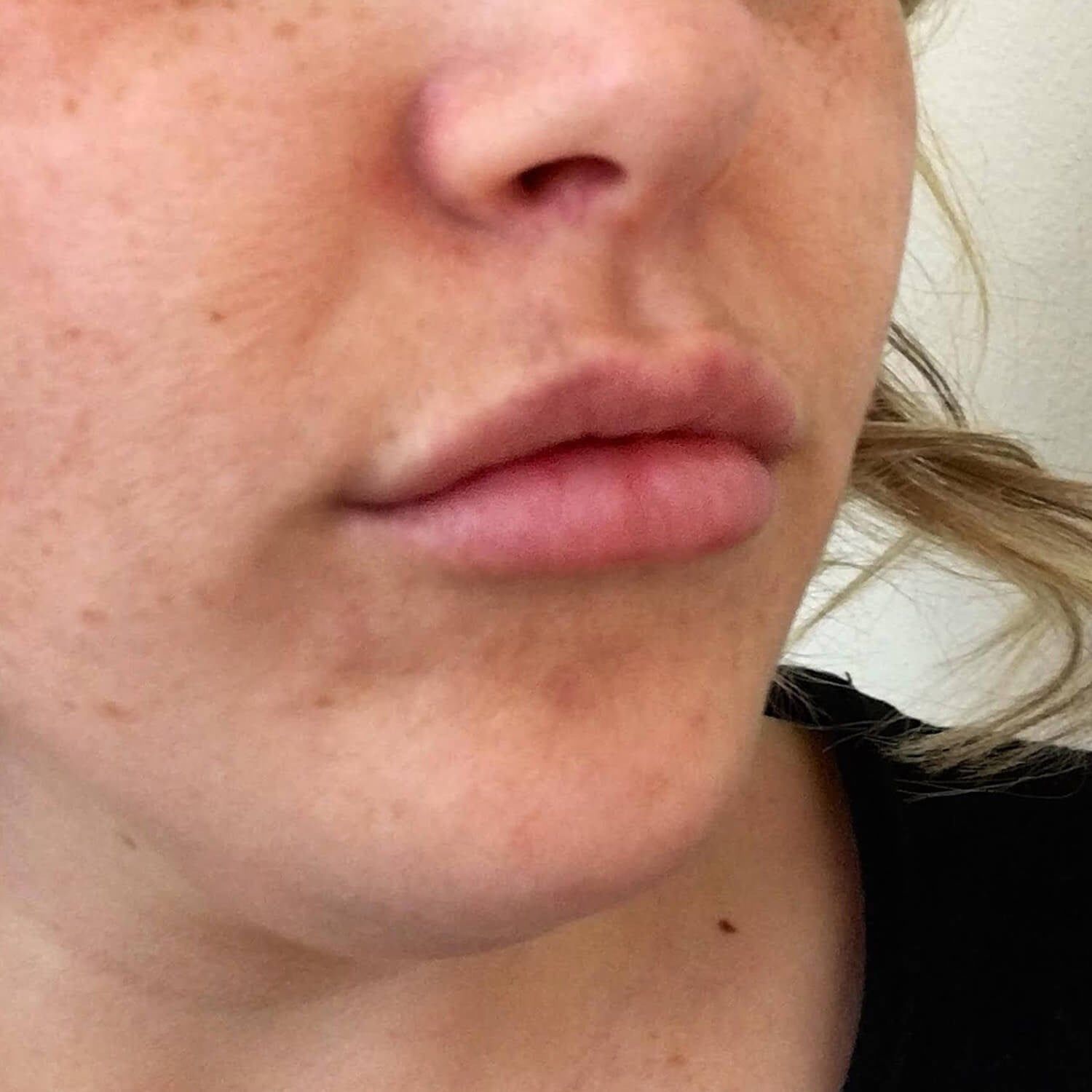 A close-up view of the lower face, showing the nose, lips, and chin, with visible skin texture.