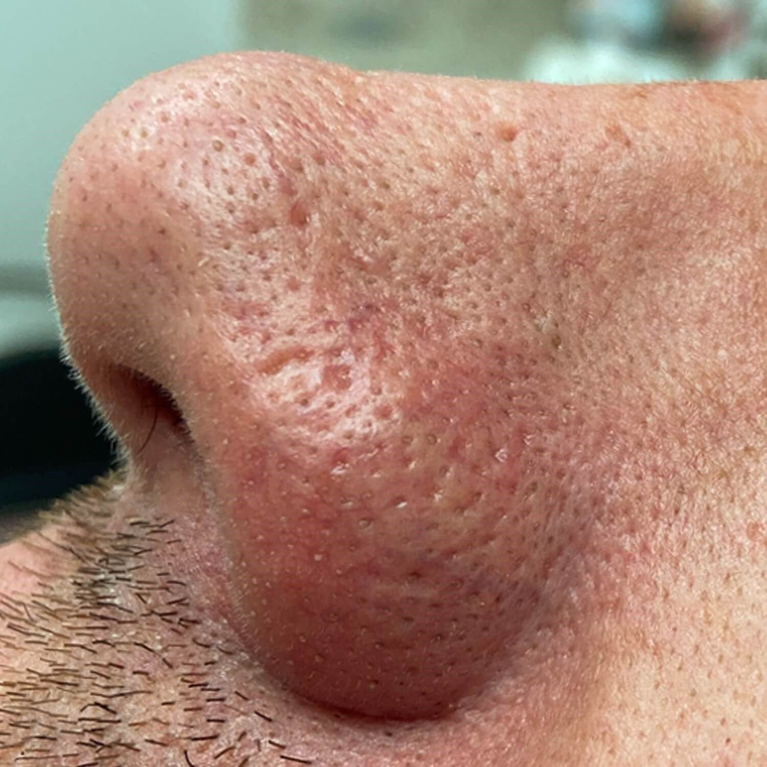 A close-up view of a person's nose and surrounding skin showing visible pores and textured skin.