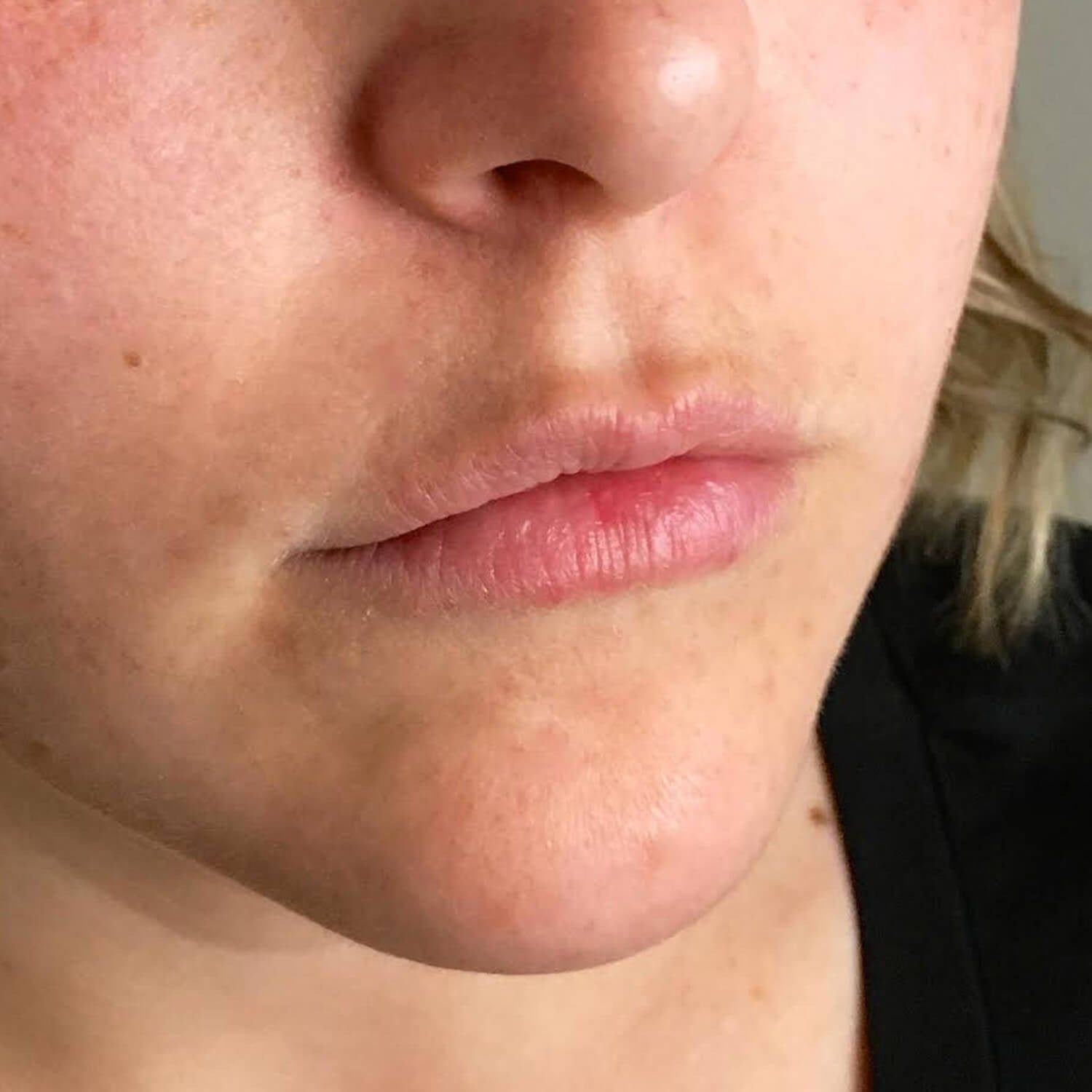 Close-up of a person's lower face showing a small, red, inflamed spot on the center of their lower lip.