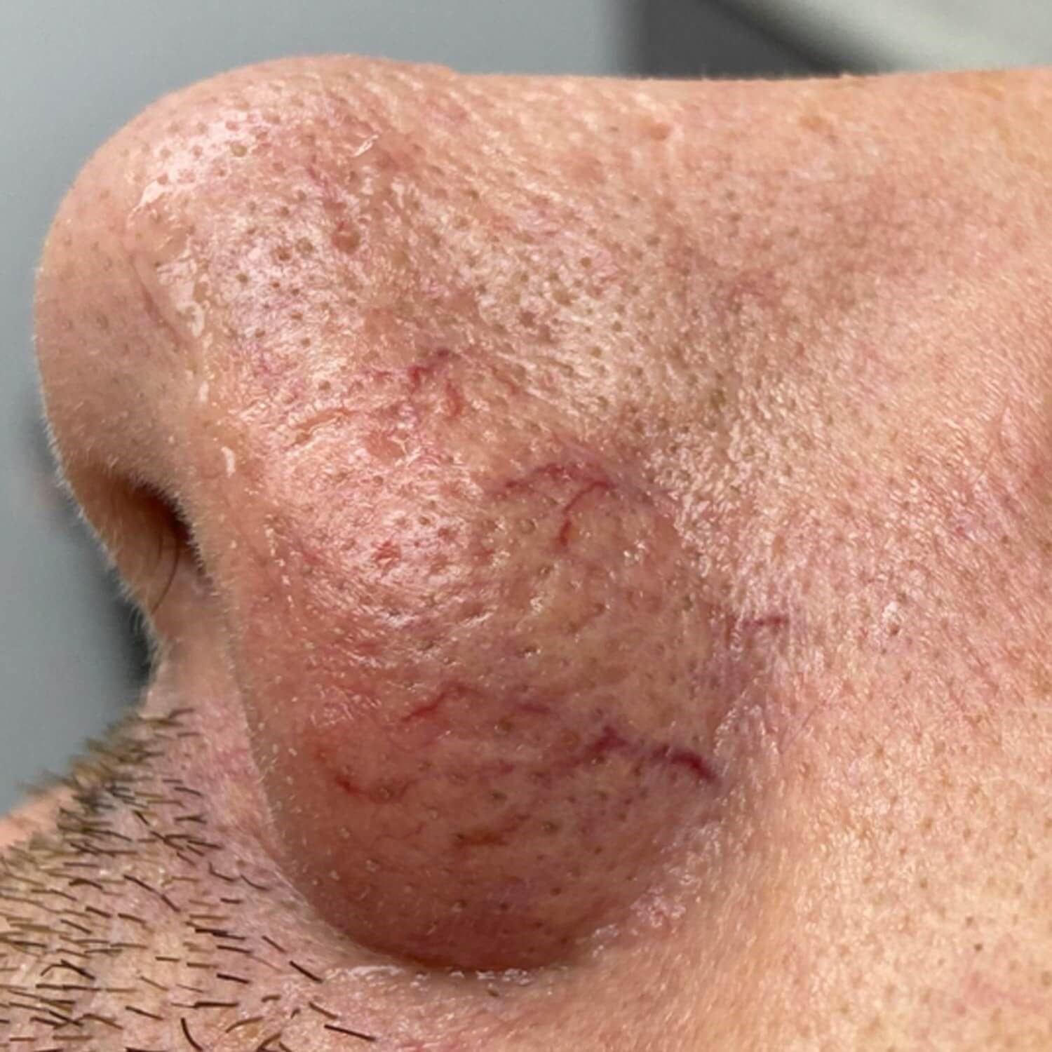 Close-up of a human nose showing visible facial capillaries, dilated blood vessels, and enlarged pores on the skin.