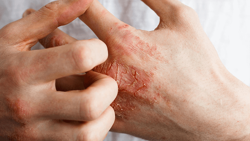 A hand scratching inflamed, red, and cracked skin on the back of the other hand, likely indicating eczema or dermatitis.