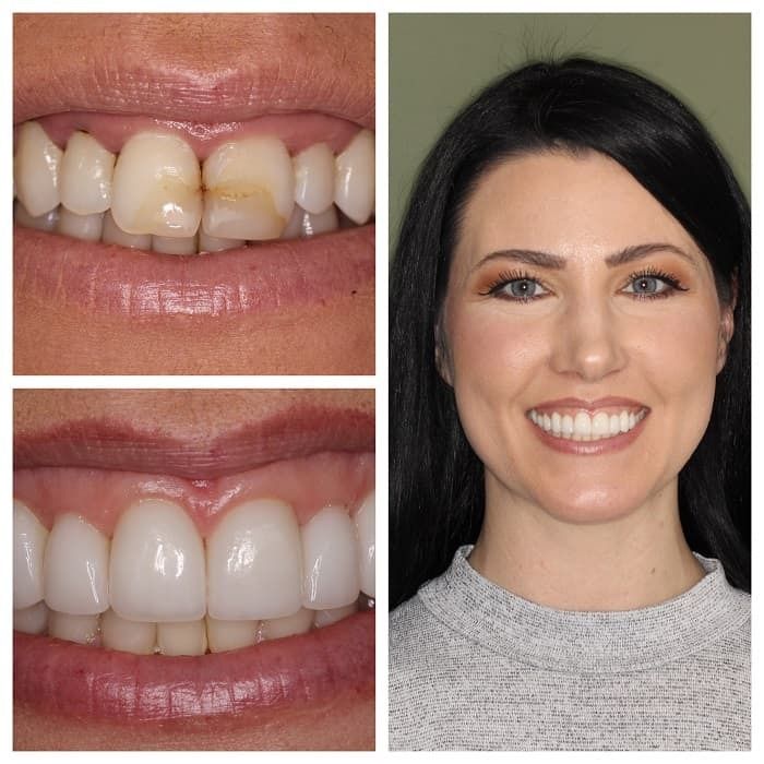 Before and after photos of a woman's teeth: chipped tooth replaced with white veneers. Smiling face.