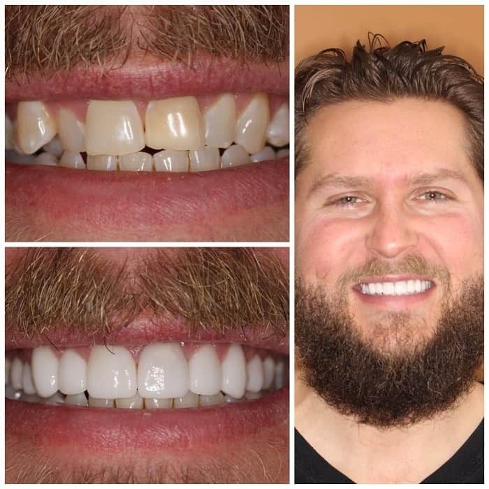 Before and after photos of a man's teeth. His smile transforms from discolored to bright white.