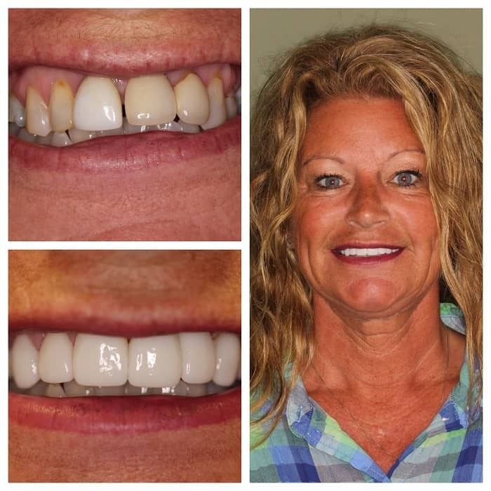 Woman's before and after smile transformation: old teeth to bright white veneers, showing happy expression.