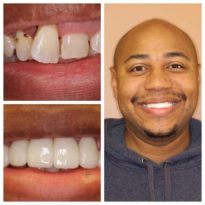 Man with dental work: before and after photos. Happy man smiles, new bright white teeth.