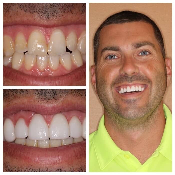 Man's before and after dental work; upper left shows chipped teeth, lower left shows new white veneers, right shows happy man smiling.