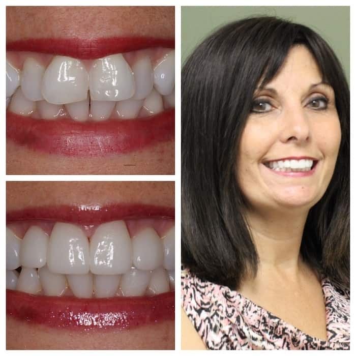 Before and after photos showing teeth: a woman's smile after cosmetic dental work.
