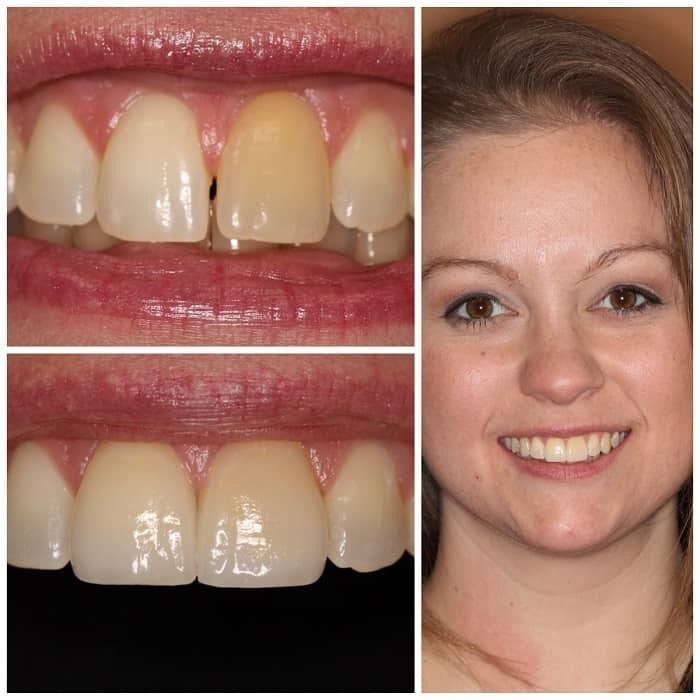 Woman's teeth before and after cosmetic dentistry. Top left: discolored tooth. Bottom left: white teeth. Right: smiling woman.