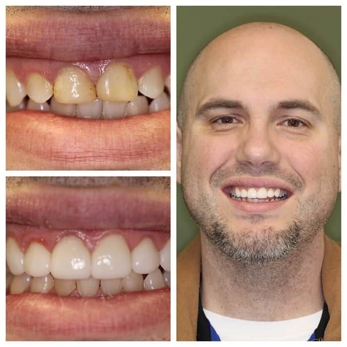 Man's teeth before and after cosmetic dentistry; discolored teeth become white. Smiling man, close-up with new teeth.