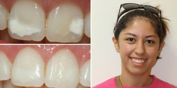 Woman with white spots on her teeth before and after dental treatment.