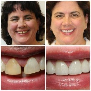 Before and after photos showing a woman's smile with gapped teeth replaced by bright white veneers.