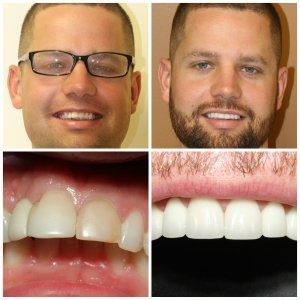 Before-and-after dental photos of a man's face and teeth; showing an improved smile with veneers.