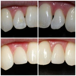 Four images show teeth before and after cosmetic dental work; teeth are whiter and the imperfections have been corrected.