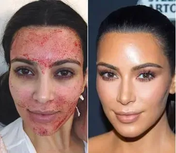 Side-by-side facial comparison: acne-prone skin on the left, smooth makeup-covered skin on the right.
