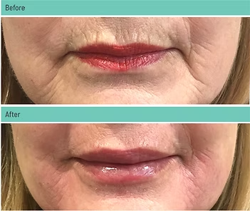 Before-and-after close-up of lips, showing a darker lip color changed to lighter, glossier lips.
