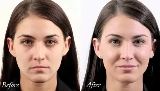 Side-by-side “Before” and “After” portraits of a woman with a more lifted, subtle smile in the after image.