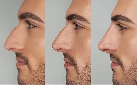 Three side-profile views of a man's face comparing nose shape