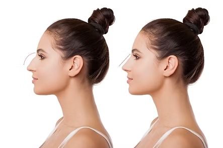 Side-by-side profile view of a woman with a dark hair bun, before and after a chin/jawline change