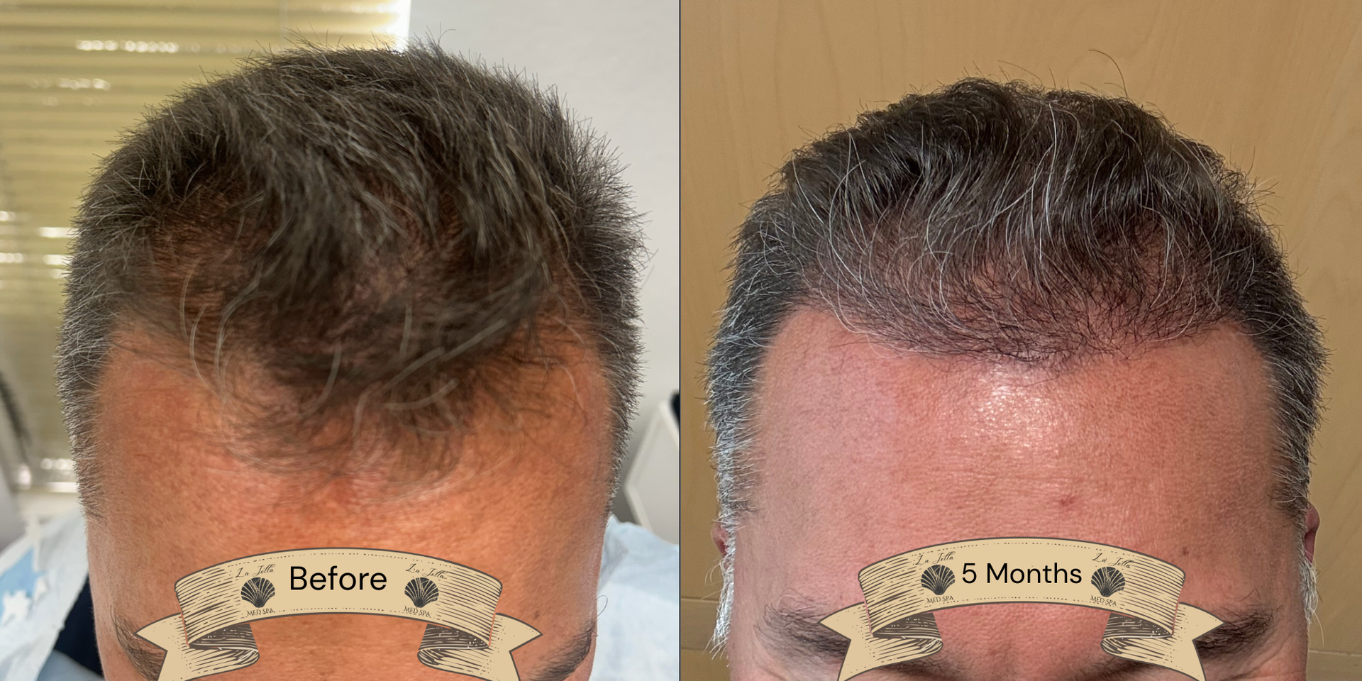Before-and-after close-up of a man’s hairline, showing thinning hair and fuller hair restoration results.