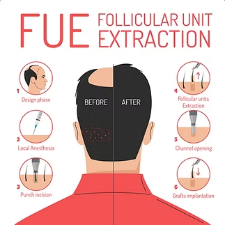 Infographic of FUE hair transplant steps with before-and-after head and procedure icons