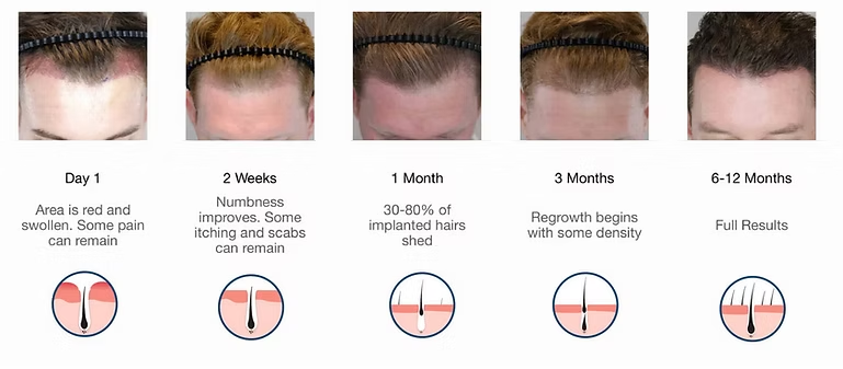 Hair growth timeline showing scalp photos from day 1 to 12 months after treatment.