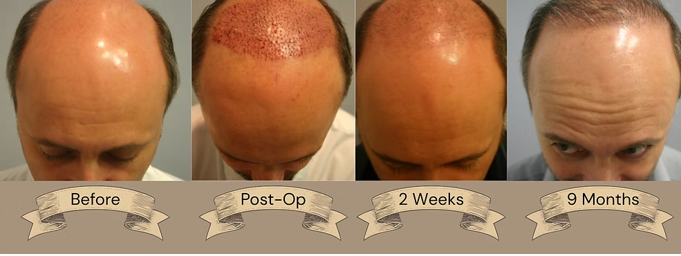Before-and-after scalp photos showing hair growth progress over 9 months.
