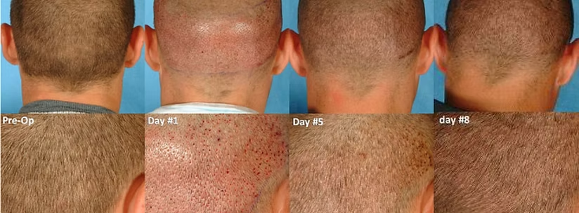 Close-up collage of a bald head showing scalp changes over several days after treatment