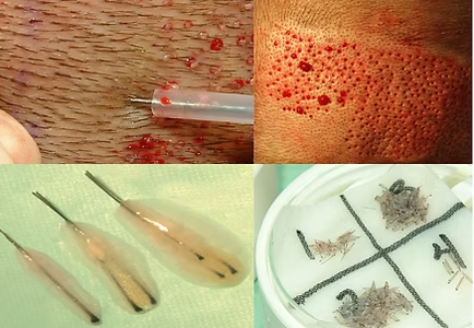 Close-up of a skin puncture with blood, alongside extracted parasitic worms in lab dishes.