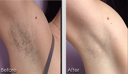 Before-and-after close-up of underarm hair removal, with the left side hairier and the right side smoother.
