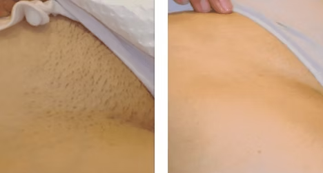 Before-and-after close-up of skin with visible hair stubble on the left and smoother skin on the right.