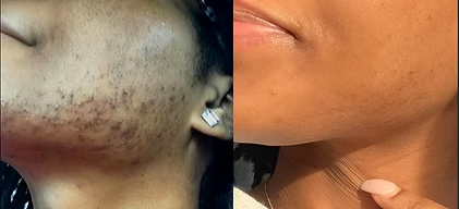 Close-up side-by-side facial skin closeups showing dark acne marks fading on the jawline and chin.