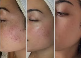 Three side-by-side close-ups of a cheek showing skin texture and acne marks in different lighting.