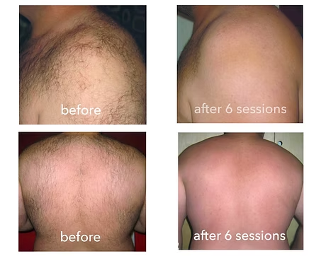 Before-and-after scalp photos showing hair thinning before and fuller hair after 6 sessions.