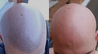 Side-by-side close-up of a bald scalp before and after treatment, showing redness and smoother skin