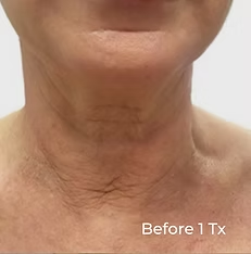 Close-up of a neck and lower chin, with visible skin folds and a 
