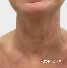 Close-up of neck and lower face with reddish rash; text reads 