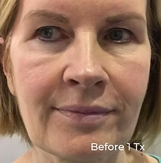Close-up of a woman’s face with light makeup and a neutral expression, labeled “Before 1 Tx.”