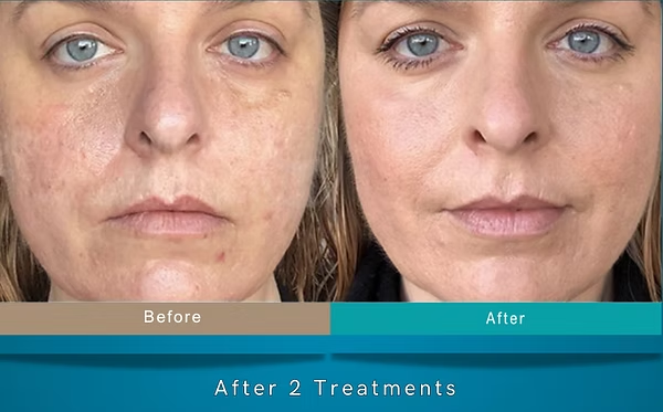 Before-and-after face comparison showing clearer skin after 2 treatments.