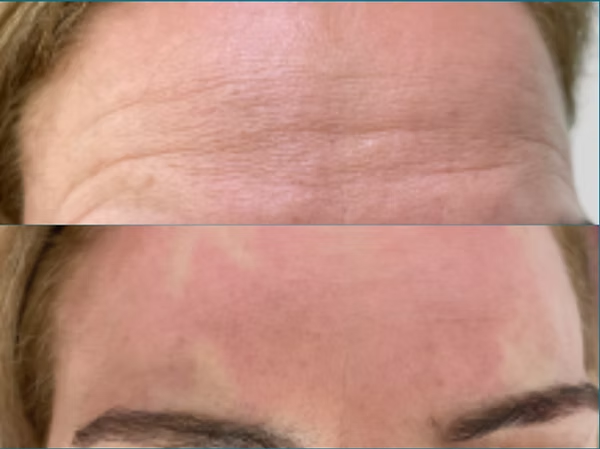 Close-up of a forehead with horizontal wrinkles and a smooth, slightly reddened forehead below
