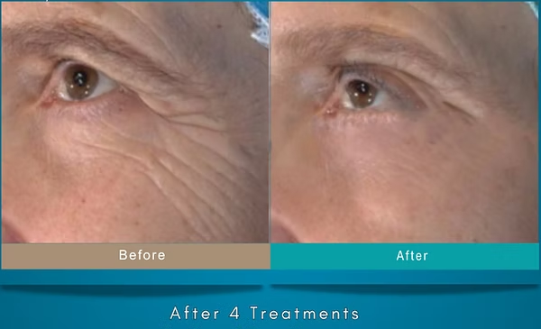 Before-and-after close-up of an eye area, showing reduced wrinkles after 4 treatments.