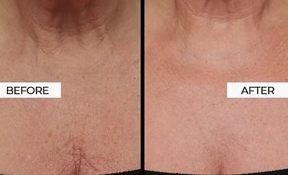 Side-by-side skin close-up labeled “BEFORE” and “AFTER,” showing reduced redness after treatment