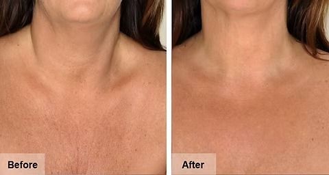 Side-by-side before-and-after close-up of a person’s neck and chest, showing smoother skin after treatment.